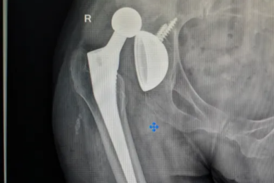 全髋关节置换术后假体脱位，急诊手法复位避免二次开刀