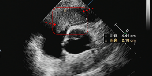 卡尼综合征—心脏手术开了三次刀，第四次谁敢接？