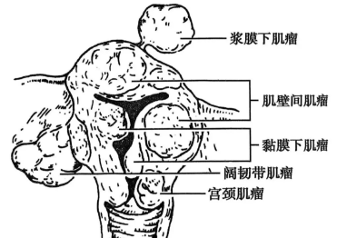 患病率超 1/4，这种肿瘤最「偏爱」育龄女性