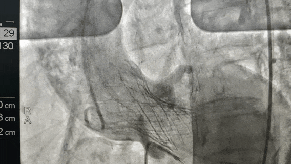 微创换瓣重启「心」动力：阜阳六院成功为 72 岁老人实施 TAVR 手术