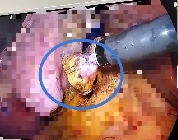 警惕！46 岁女性因担心术后并发症拖延治疗，胆结石引发多重危机