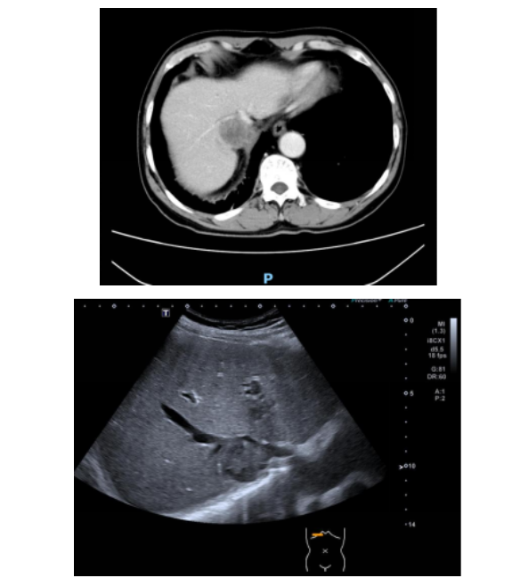 精准「穿针引线」破难题！南大二附院超声介入团队成功完成高难度肝 S1 段占位穿刺活检