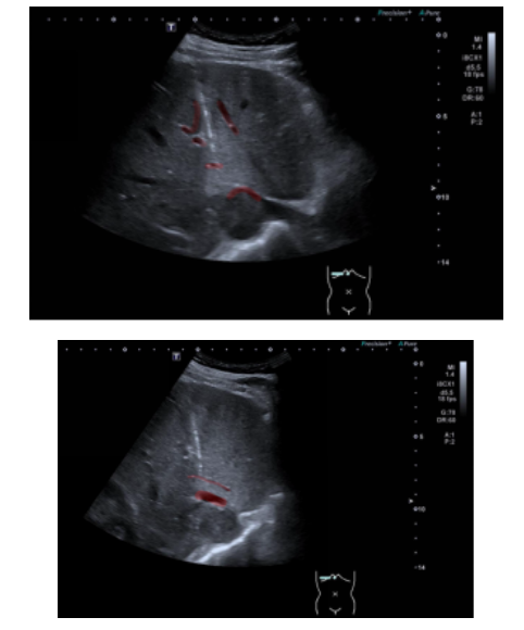 精准「穿针引线」破难题！南大二附院超声介入团队成功完成高难度肝 S1 段占位穿刺活检