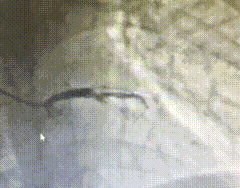 七年前的支架成「摆设」，云霄大爷深夜再闯鬼门关