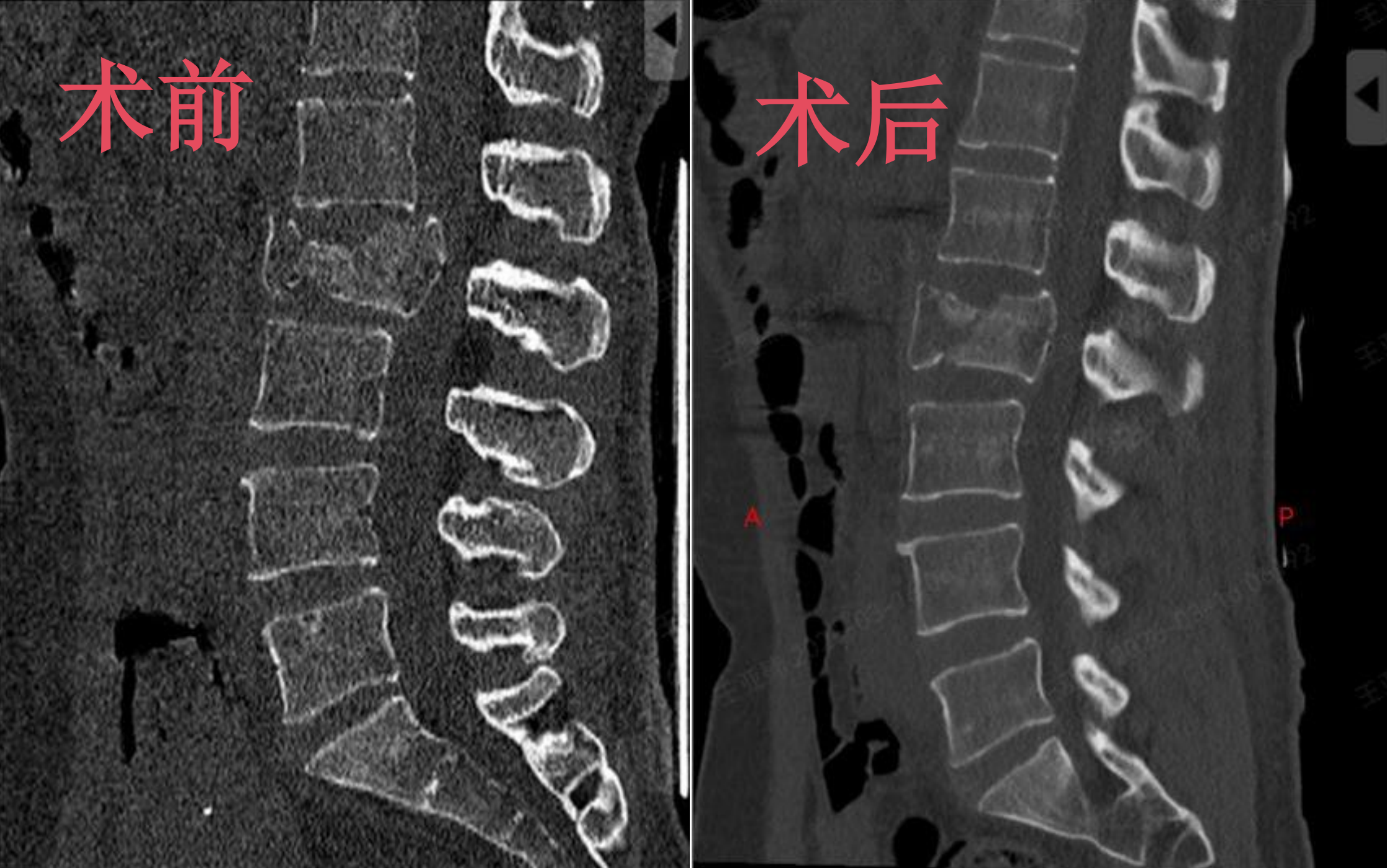 精准微创护脊柱!机器人助力脊柱骨折患者快速康复