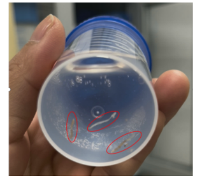 精准「穿针引线」破难题！南大二附院超声介入团队成功完成高难度肝 S1 段占位穿刺活检