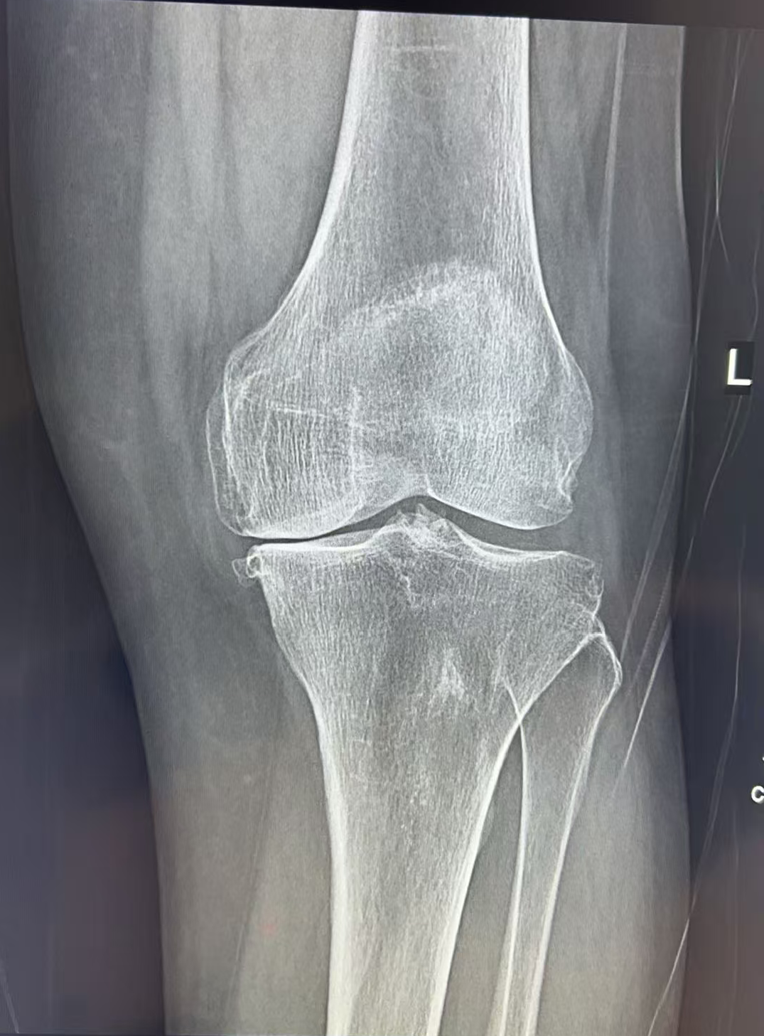 注意了！这种中老年常见疾病，越早关注，爸妈痛苦越少