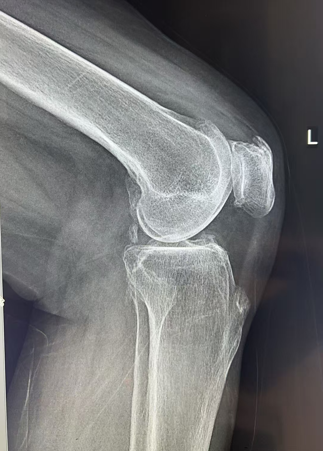 注意了！这种中老年常见疾病，越早关注，爸妈痛苦越少