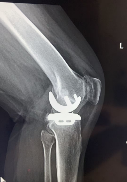 注意了！这种中老年常见疾病，越早关注，爸妈痛苦越少