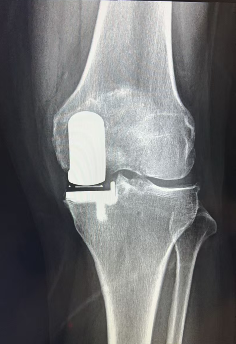 注意了！这种中老年常见疾病，越早关注，爸妈痛苦越少