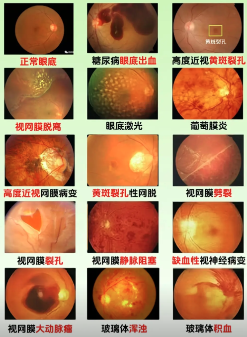 为什么眼底病很少吃药输液？一文读懂背后的医学道理