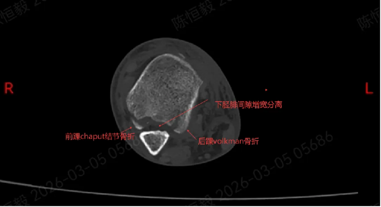 警惕!崴脚不是「小磕碰」,不要因轻视错过最佳治疗