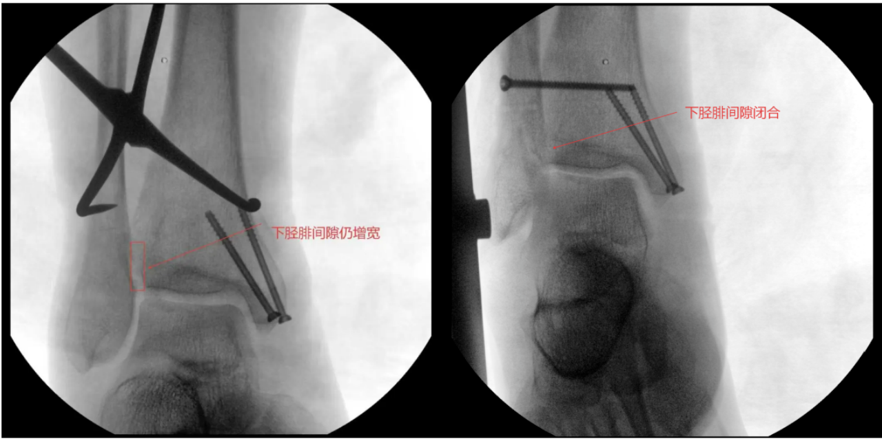 警惕!崴脚不是「小磕碰」,不要因轻视错过最佳治疗