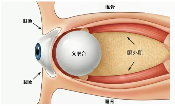 一拖就是 30 年,她终于决定为自己佩戴义眼