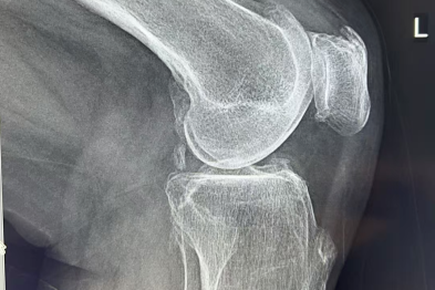 注意了！这种中老年常见疾病，越早关注，爸妈痛苦越少