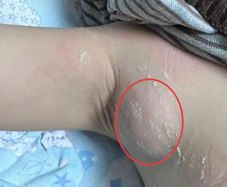 3 岁女娃腋下长包剧痛,元凶竟是「猫抓了一下」