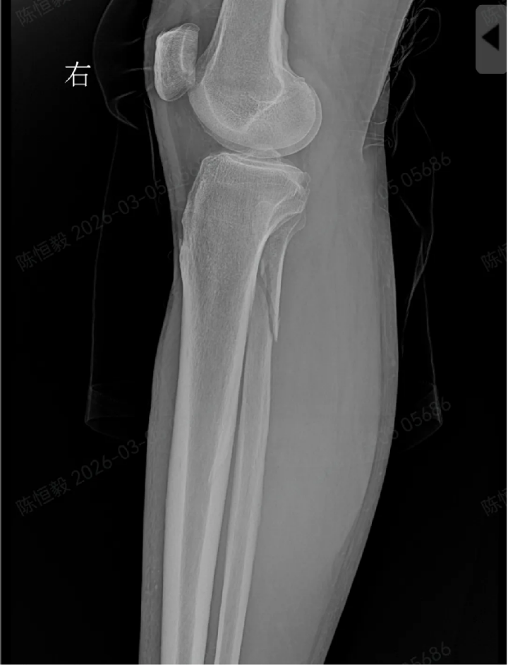 警惕!崴脚不是「小磕碰」,不要因轻视错过最佳治疗