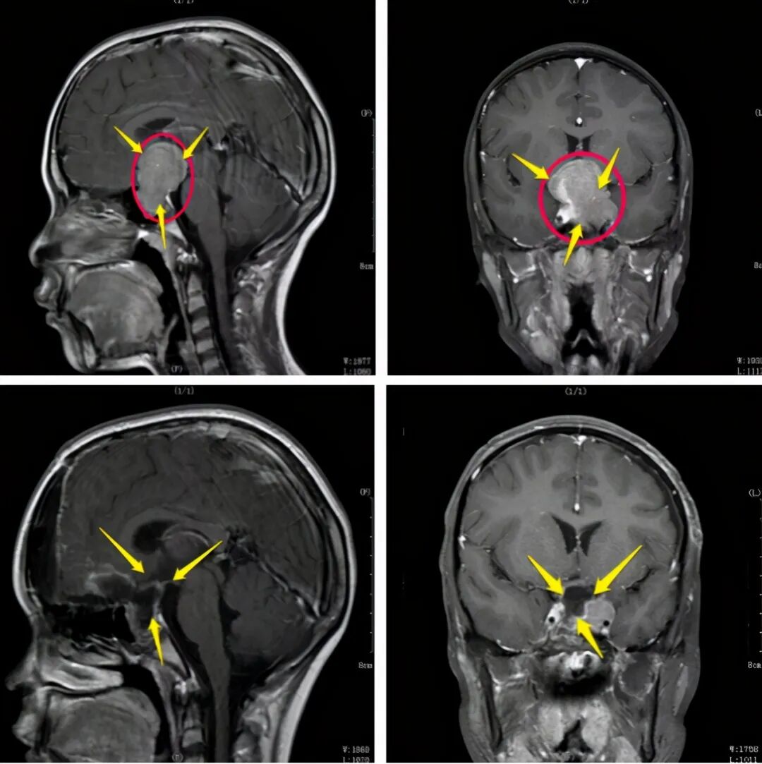 儿童脑肿瘤极易误诊耽误治疗，出现这些症状不可忽视儿童脑肿瘤可能！