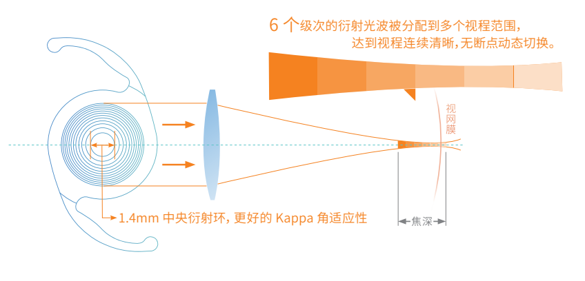 全国首批万视安® Ultra-EDoF 人工晶状体在北京华厦民众眼科医院成功植入 为白内障患者带来新选择