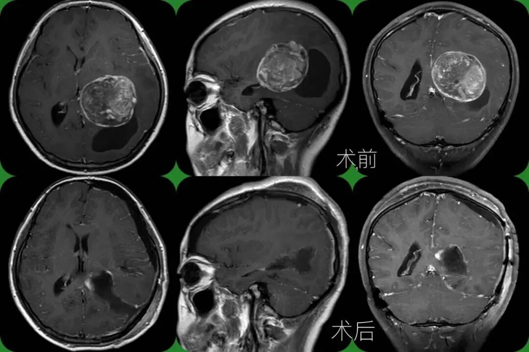 儿童脑肿瘤极易误诊耽误治疗，出现这些症状不可忽视儿童脑肿瘤可能！