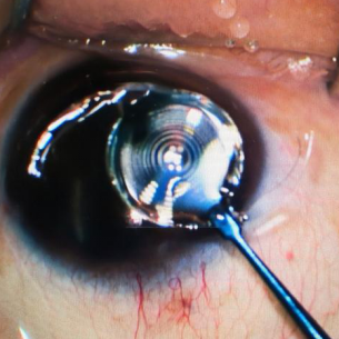 全国首批万视安® Ultra-EDoF 人工晶状体在北京华厦民众眼科医院成功植入 为白内障患者带来新选择