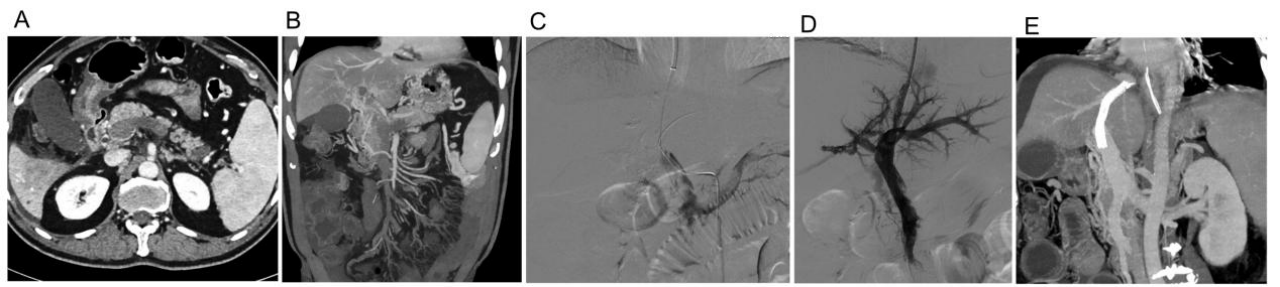 南大二附院介入科在门静脉血栓的病因及精准防治研究领域取得重大突破