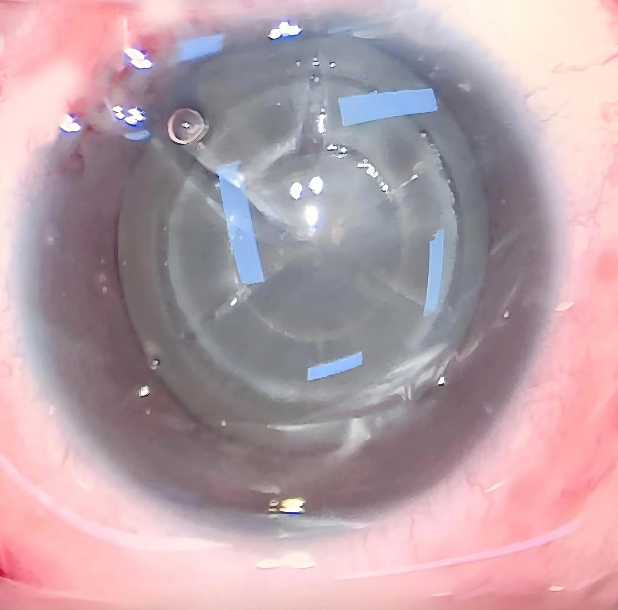 47 岁女子高度近视合并白内障，武汉普瑞眼科医院个性化手术助其重获清晰视界