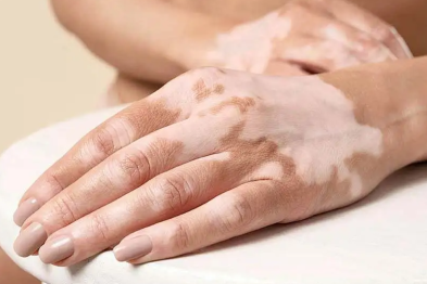 白癜风新特药「芦可替尼」正式引进