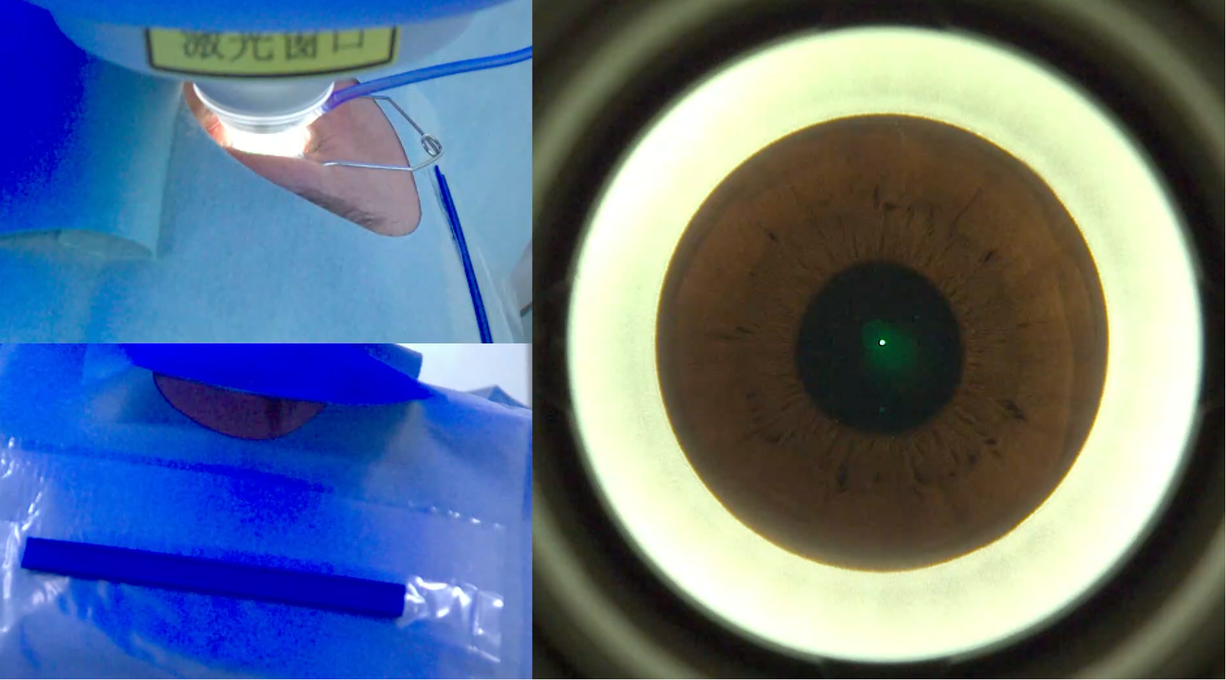 陪护家属「顺手」摘镜 北京华厦民众眼科医院 SMILE Pro 手术助其重获清晰「视」界