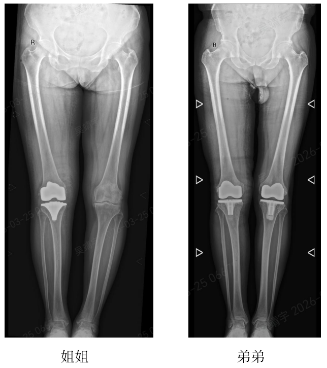 郑州市中心医院机器人精准微创换膝!
