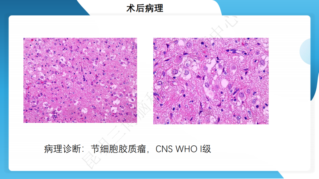 手术治疗神经节细胞胶质瘤继发难治性癫痫 1 例