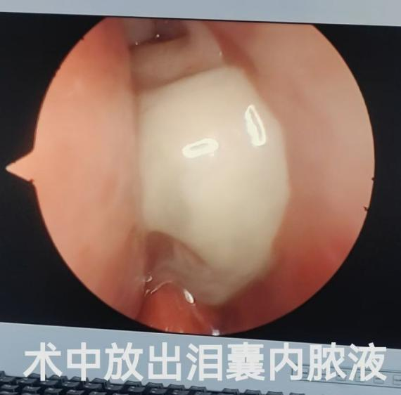 急性泪囊炎别硬扛，久拖不治遭大罪！