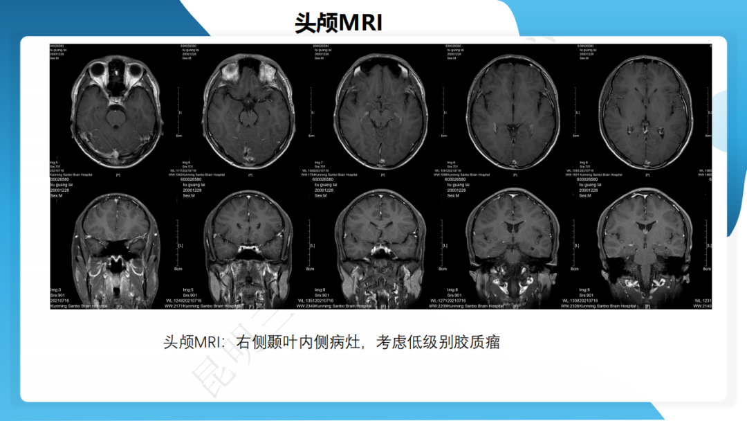手术治疗神经节细胞胶质瘤继发难治性癫痫 1 例