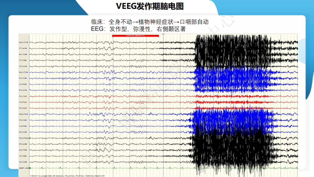 手术治疗神经节细胞胶质瘤继发难治性癫痫 1 例