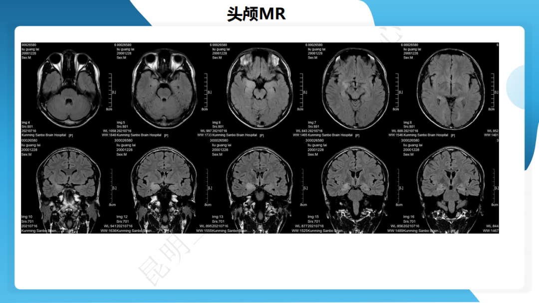 手术治疗神经节细胞胶质瘤继发难治性癫痫 1 例