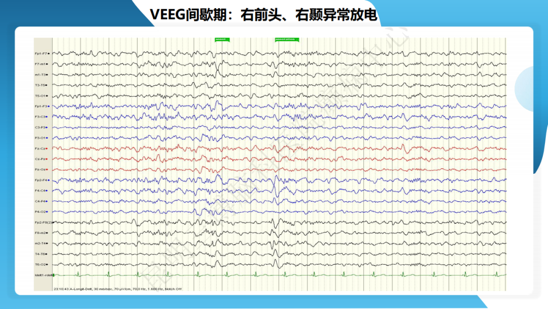 手术治疗神经节细胞胶质瘤继发难治性癫痫 1 例