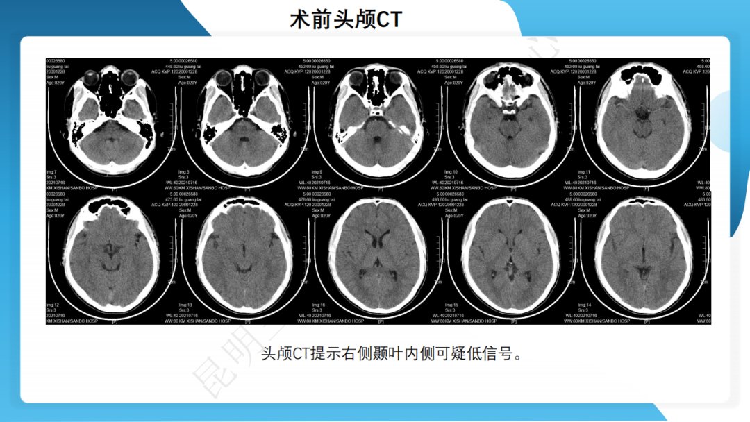 手术治疗神经节细胞胶质瘤继发难治性癫痫 1 例