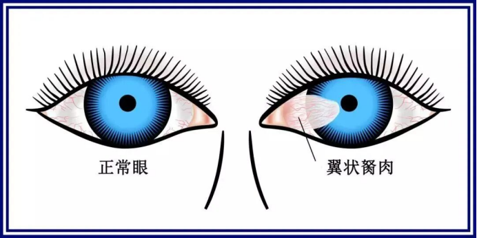 眼睛表面长了一块肉该怎么办？武汉普瑞眼科李强科普翼状胬肉治疗