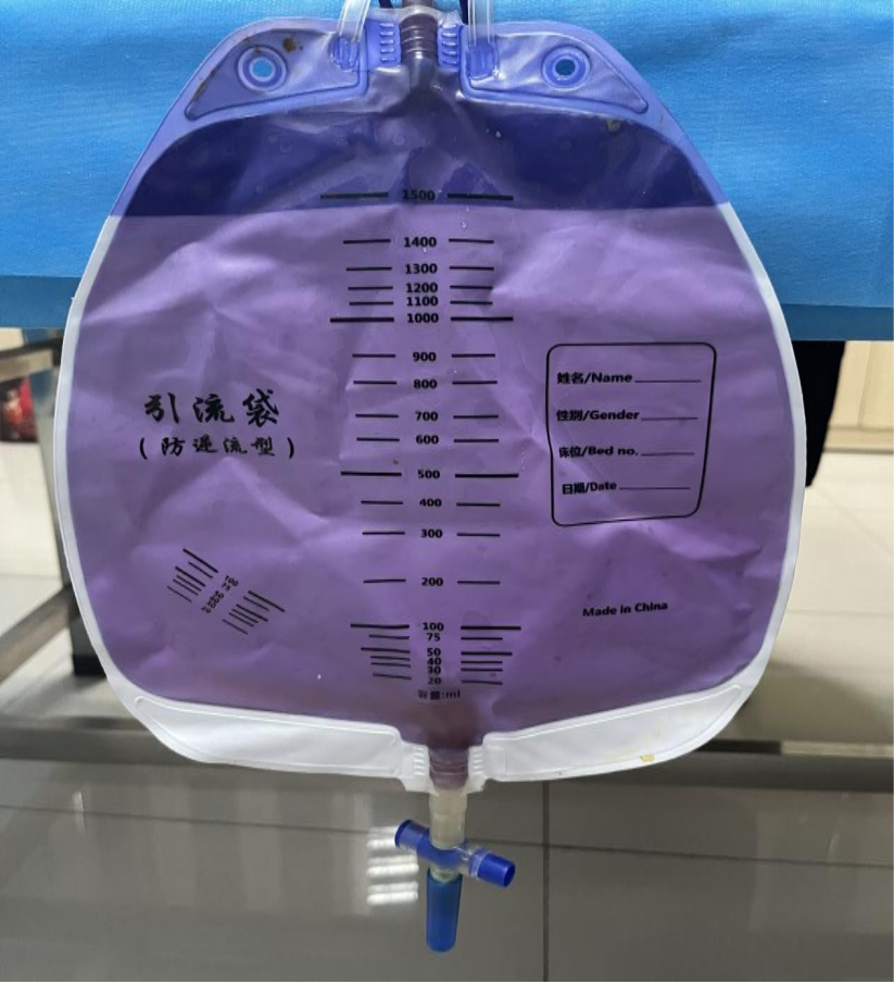 尿液变紫别慌！警惕这种罕见病症——紫色尿袋综合征