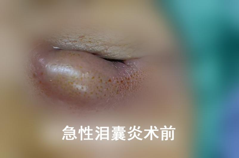 急性泪囊炎别硬扛，久拖不治遭大罪！
