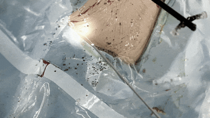 密集恐惧症慎入！男子肾脏里取出上万颗砂石