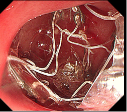 28 岁小伙 200 斤，在内镜下找到「减重新通路」