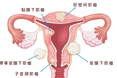 更年期的子宫肌瘤治疗，何时需要干预？