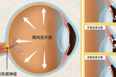 青光眼悄悄「偷走视力」？眼科微创手术带来新希望！