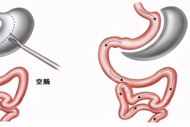 4 年负重前行终获「解脱」，腹腔镜袖状胃切除术助极重度肥胖患者重获新生