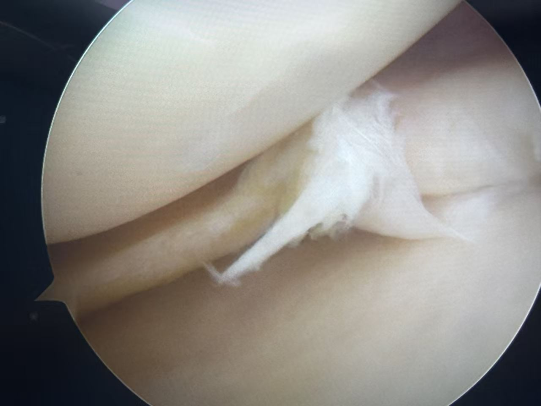 精准探查解困惑  微创诊疗除病痛——膝关节镜微创技术巧解不明原因膝关节反复肿痛病症