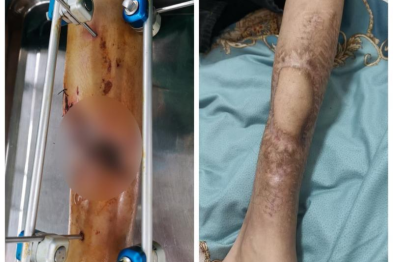 13 岁少年小腿骨折后感染坏死，合肥京东方医院两年「保肢战」