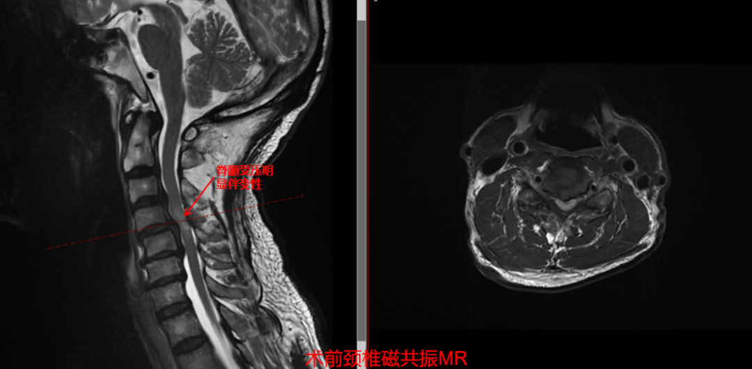 妙手解危局，仁术护安康  市中心医院脊柱外科助高龄危重颈椎病患者重获新生