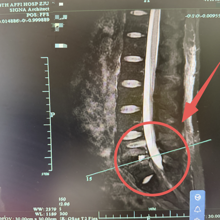 跨越 3 万里,从非洲到义乌:严重腰椎病患者的「微创」重生之路