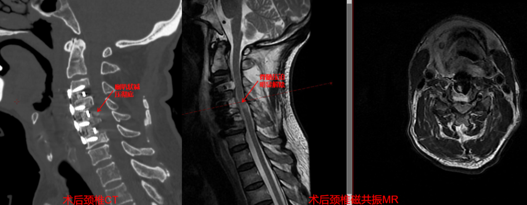 妙手解危局，仁术护安康  市中心医院脊柱外科助高龄危重颈椎病患者重获新生